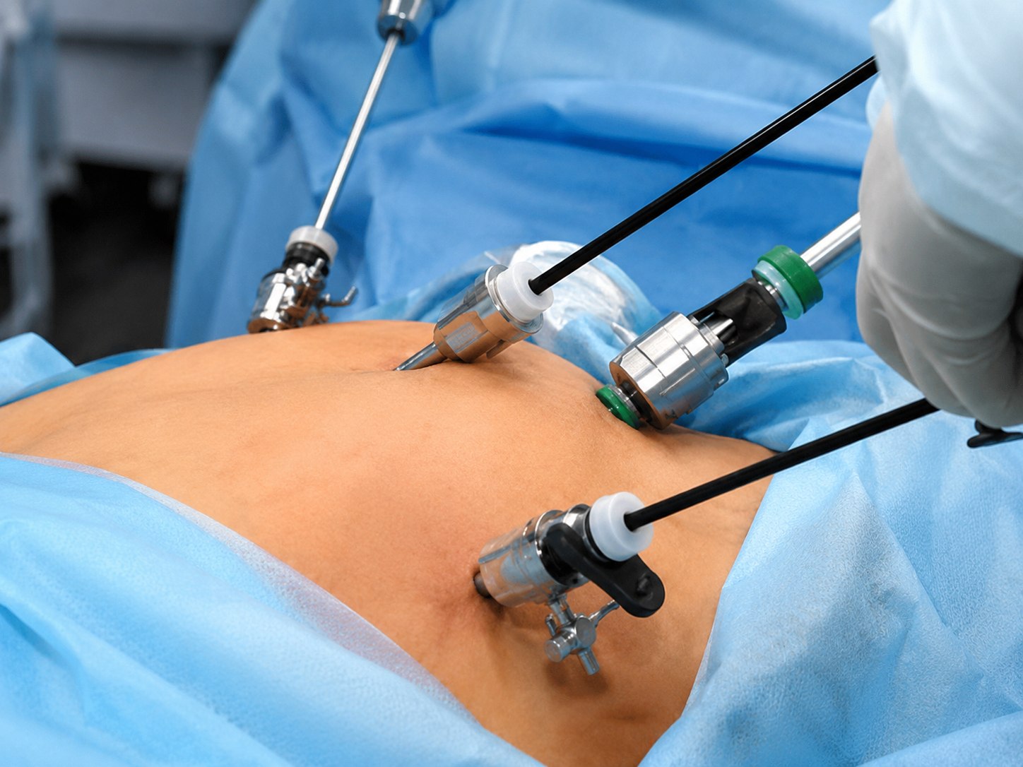 Laparoscopic surgery